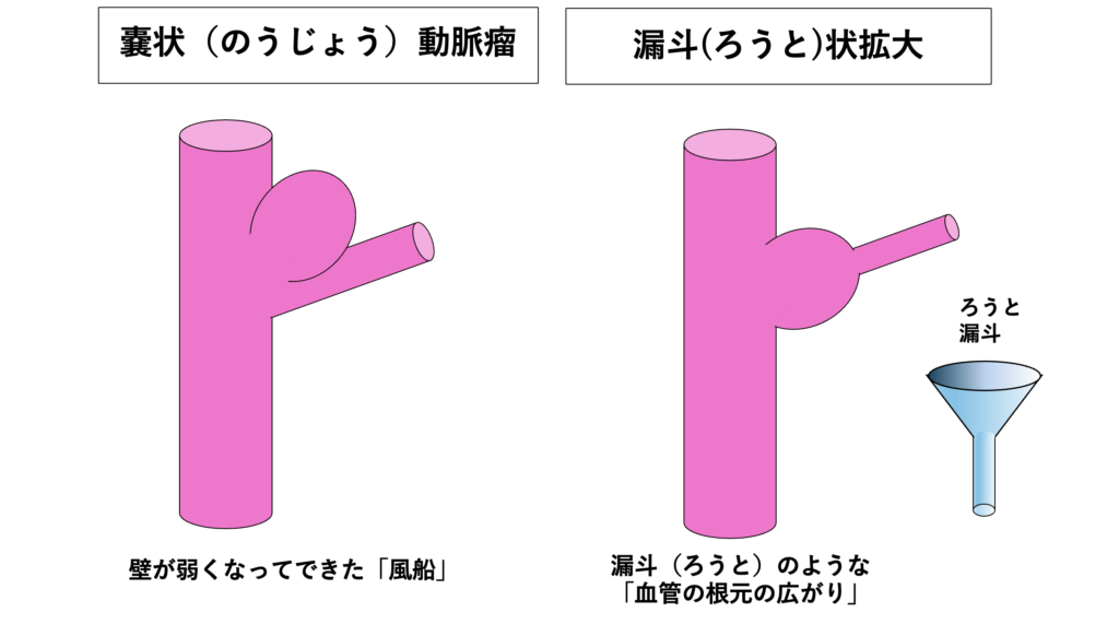動脈瘤のようなふくらみ - 「漏斗状拡大」とは何か?