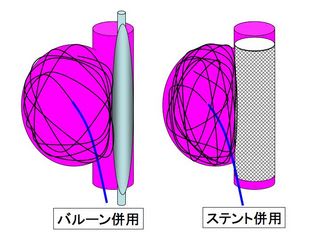 未破裂動脈瘤の治療法選択ー血管内手術（近未来編）