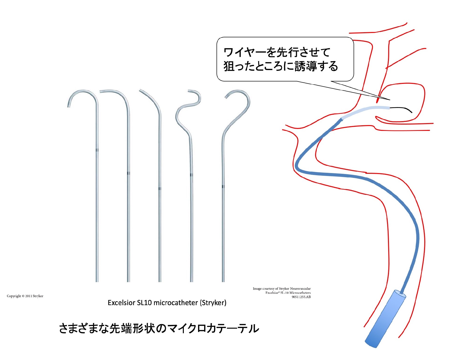 脳動脈瘤 その34 脳血管内治療：その4 マイクロカテーテルの誘導