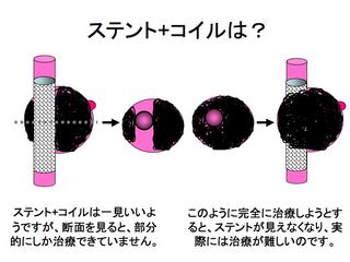 難しい動脈瘤2