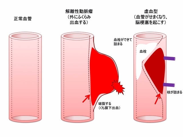 脳動脈瘤 その7 脳動脈瘤の種類(成因による分類) 解離性動脈瘤