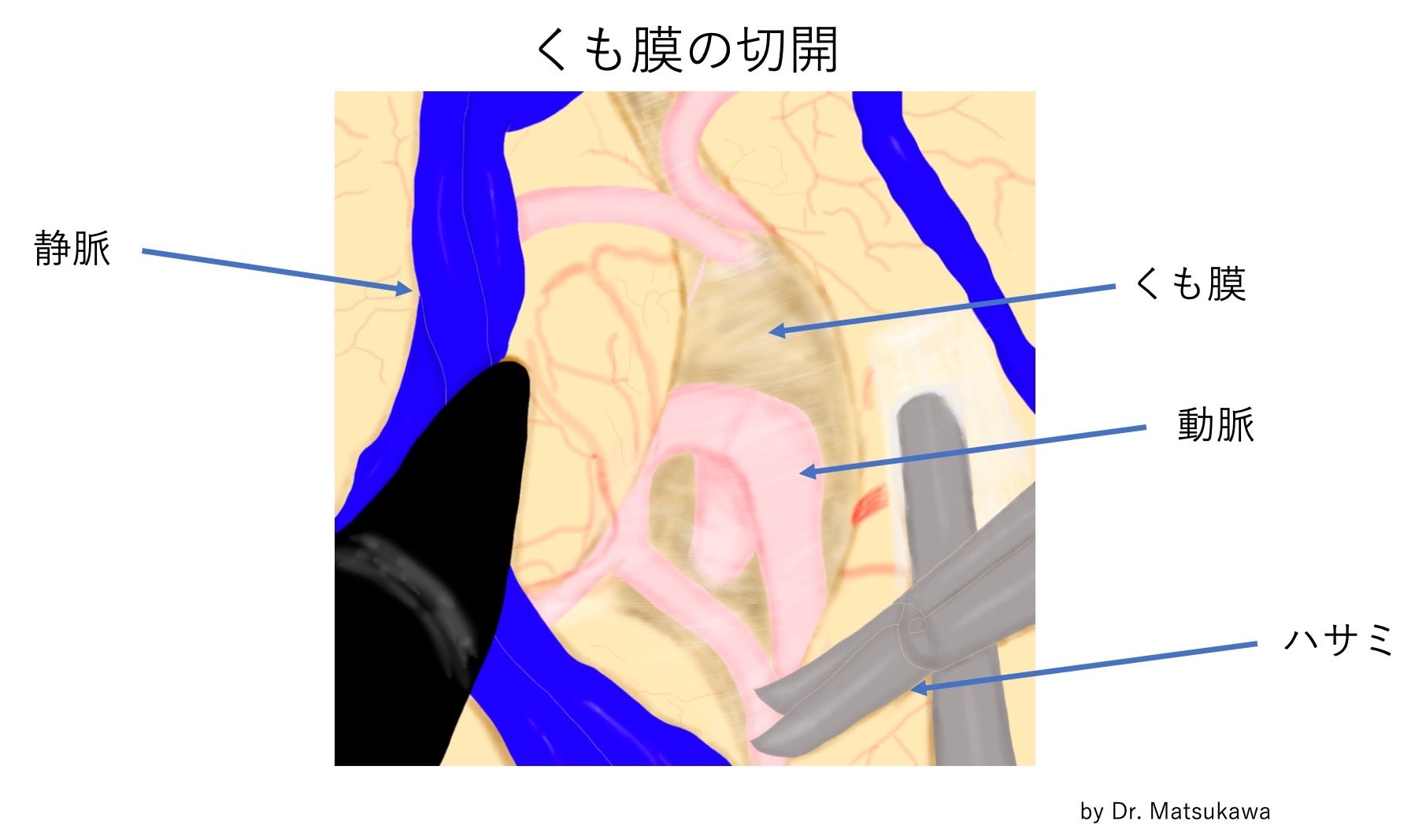 脳動脈瘤 その20 外科手術 1. クリッピング術 「どのように進んでいくのか？」