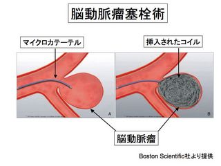 くも膜下出血ー治療法選択 コイル塞栓術