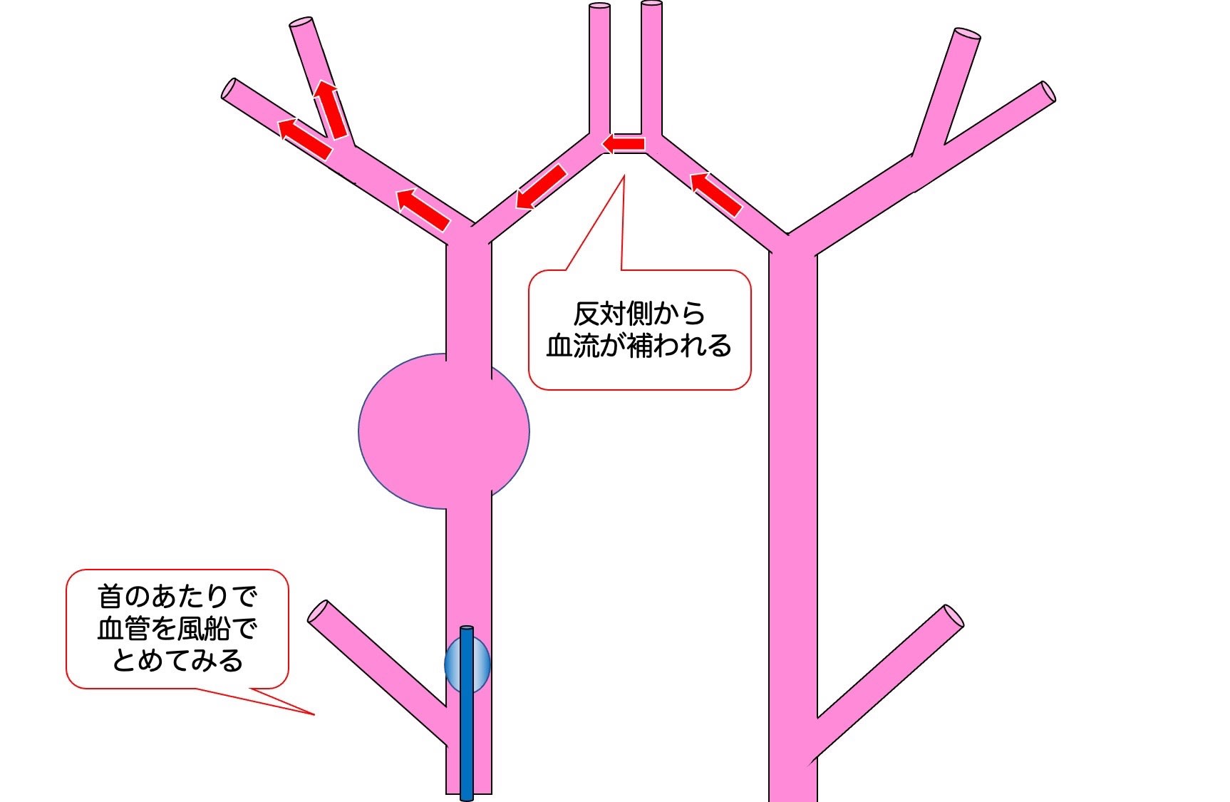 脳動脈瘤 その30 外科手術が難しい動脈瘤：大型・巨大動脈瘤 治療の工夫5
