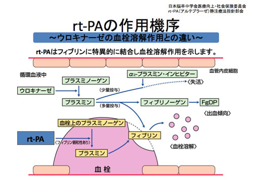 脳梗塞の治療　tPA静注療法
