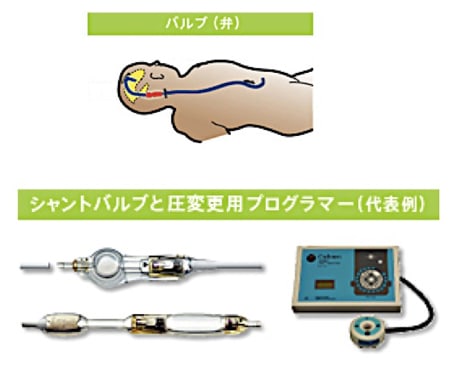 水頭症の手術:脳室腹腔短絡術(シャント術)その2