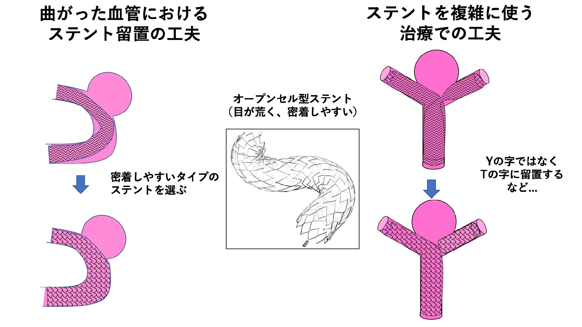 脳動脈瘤 コラム 「血管内治療でも血管が詰まることがあるのか?」(前編つづき)