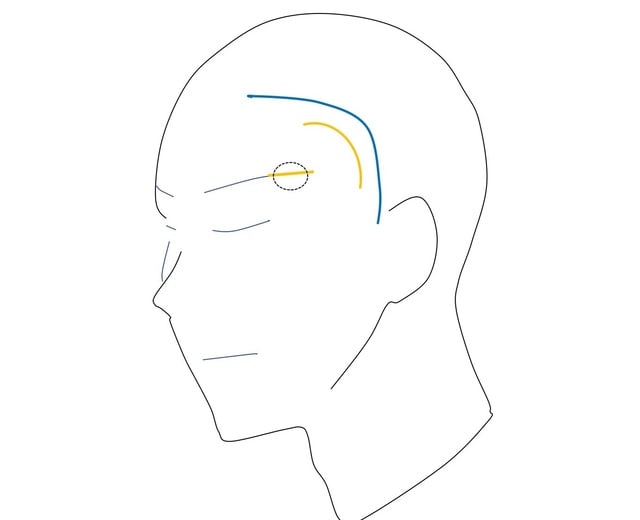 脳動脈瘤 その17 外科手術 1. クリッピング術 「もっと小さい傷でできないのか？」