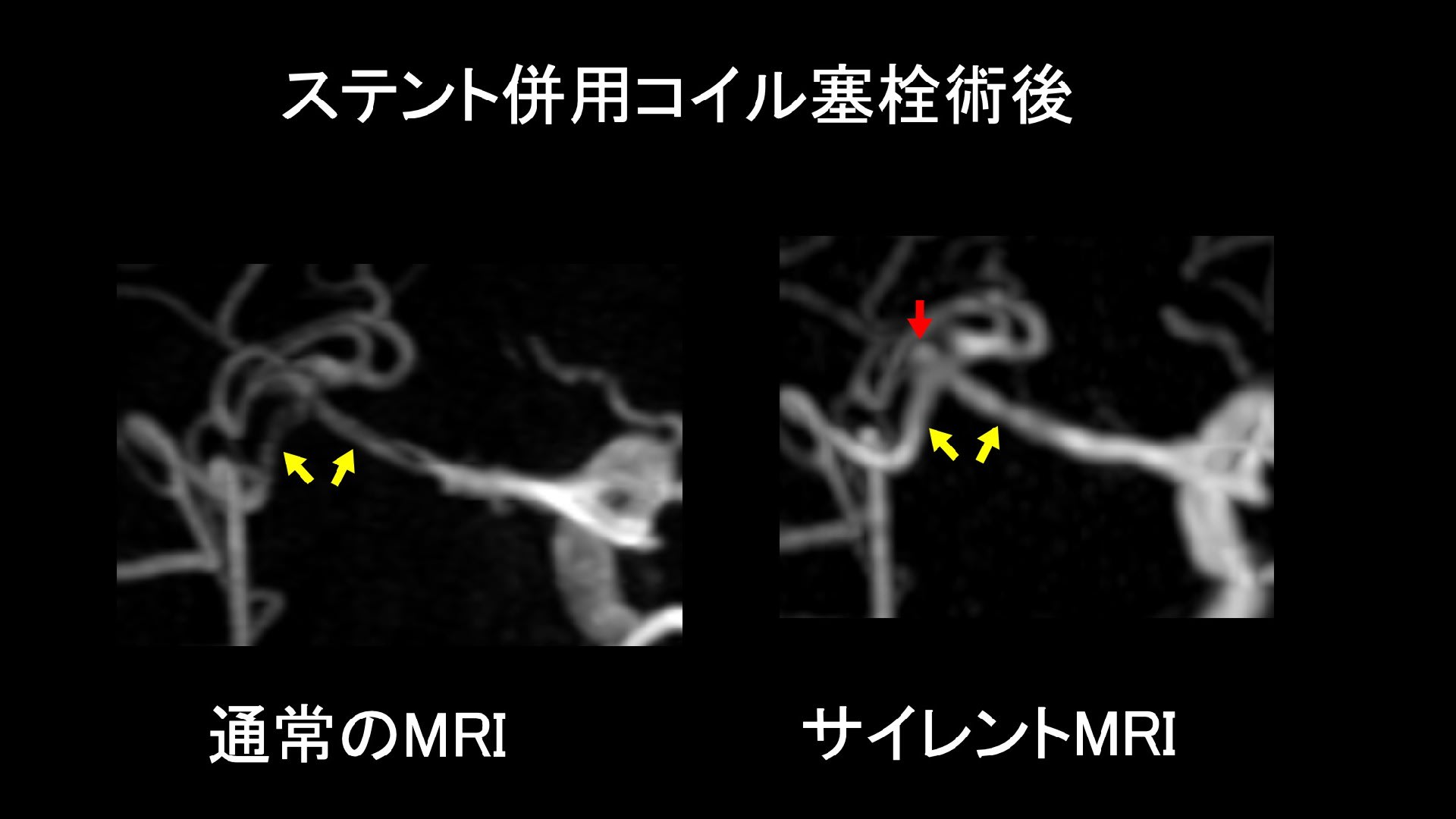 脳動脈瘤についてのQ&A その９　コイル塞栓術後の検査は何が良いか？