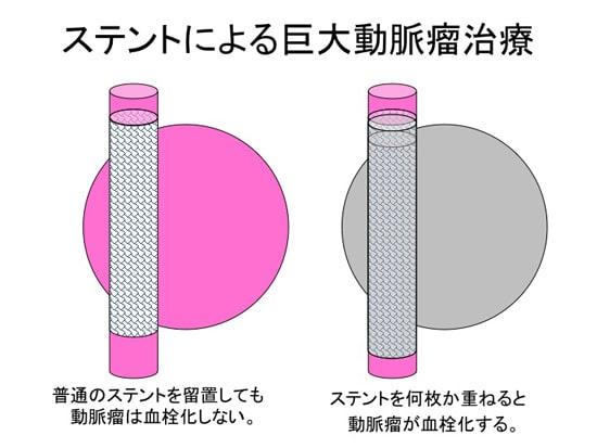 巨大動脈瘤の新しい治療法
