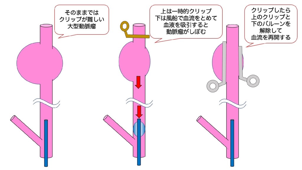脳動脈瘤 その27 外科手術が難しい動脈瘤：大型・巨大動脈瘤 治療の工夫2