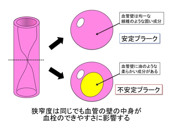 血管の狭窄４