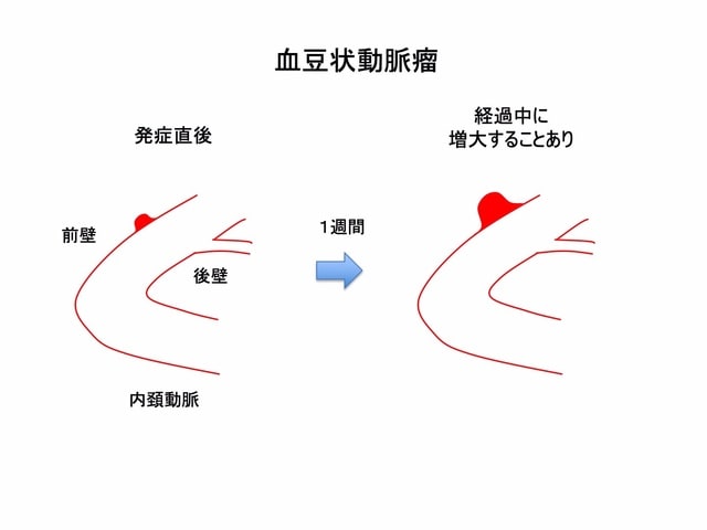 脳動脈瘤 その8 脳動脈瘤の種類(成因による分類) 血豆状動脈瘤