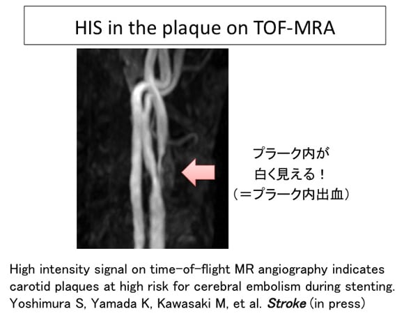 MRAによる頚動脈プラーク診断がStroke誌にアクセプトされました！