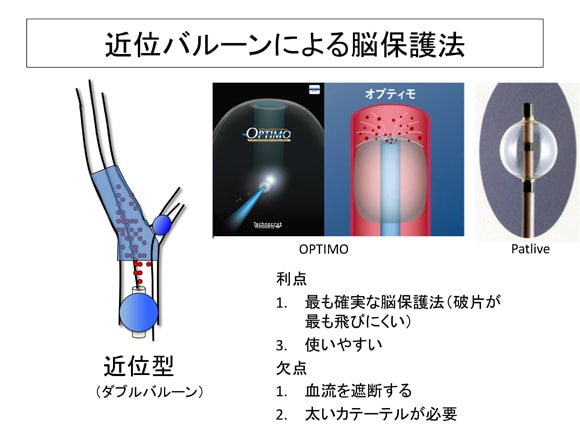 近位閉塞による脳保護