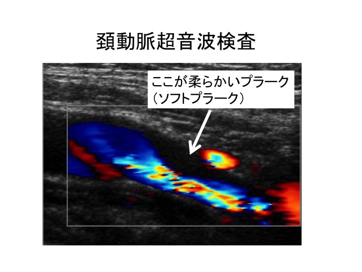 血管の壁を判定する方法