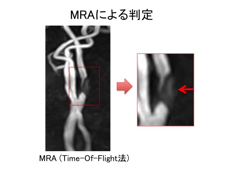 MRでの判定法