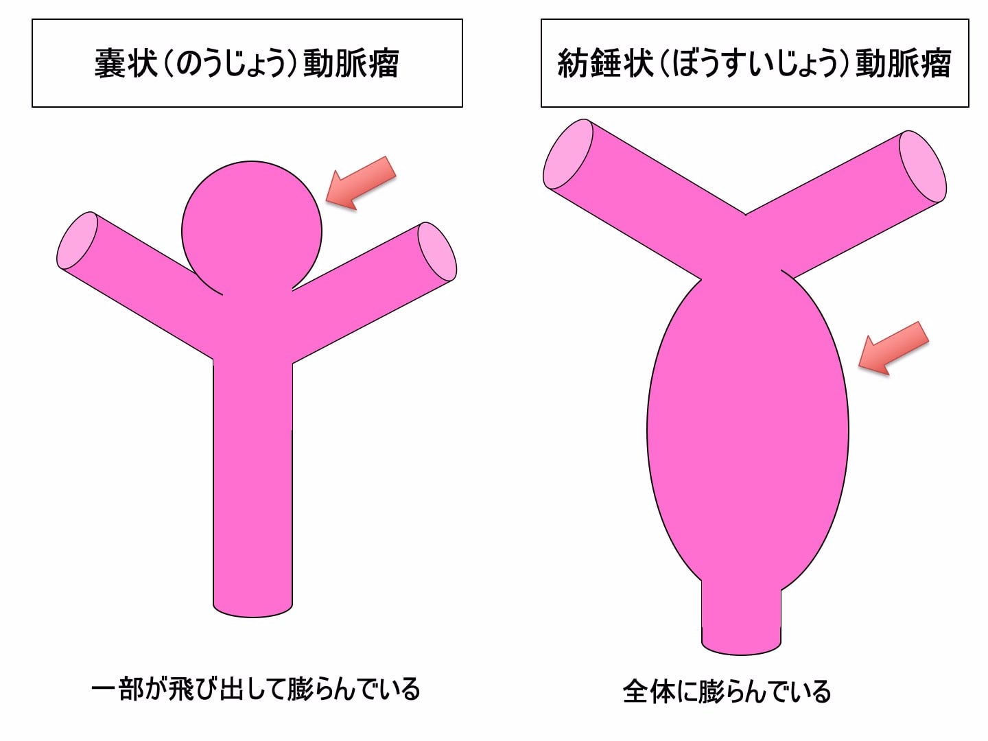 脳動脈瘤 その6 脳動脈瘤の種類 （形による分類）