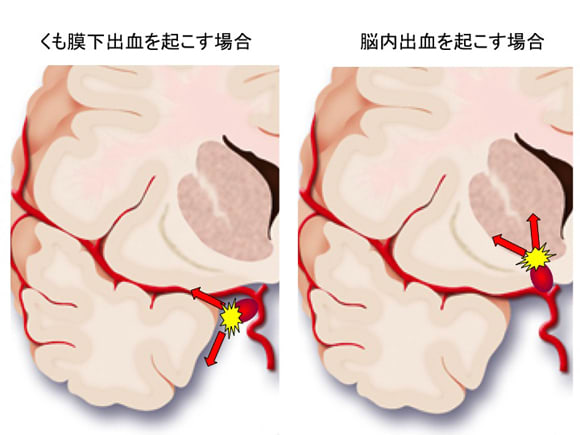 脳内出血だけを起こす動脈瘤