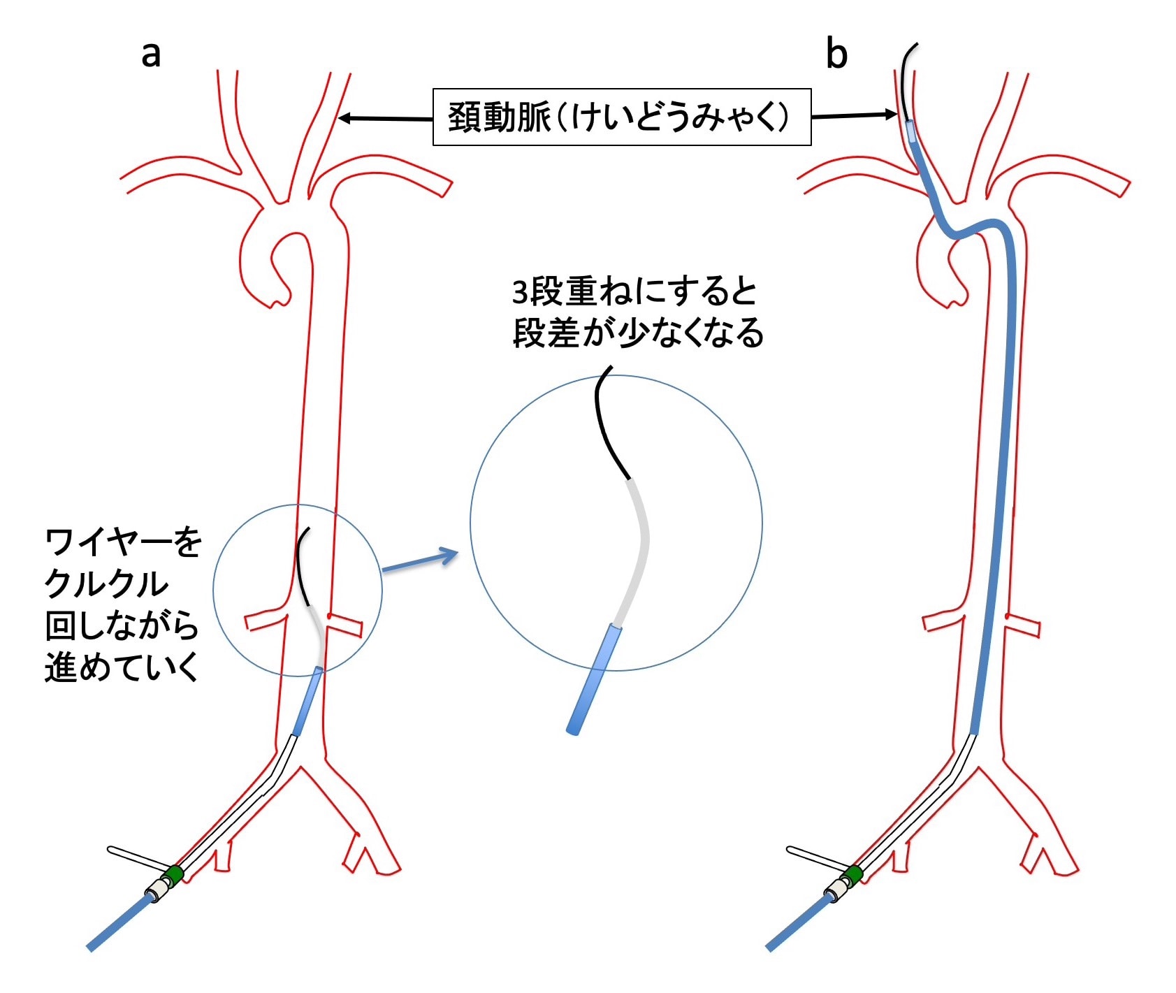 脳動脈瘤 その33 脳血管内治療:その3 血管内への管の進め方
