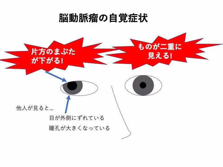 脳動脈瘤 その12 脳動脈瘤の症状: ものが二重に見えたら要注意!