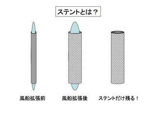 ステントとは？