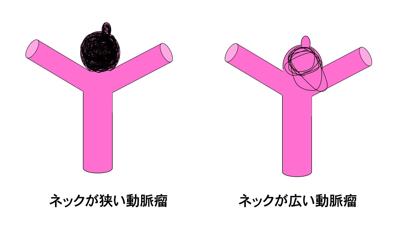 脳動脈瘤 その36 脳血管内治療:その6 動脈瘤治療のテクニック