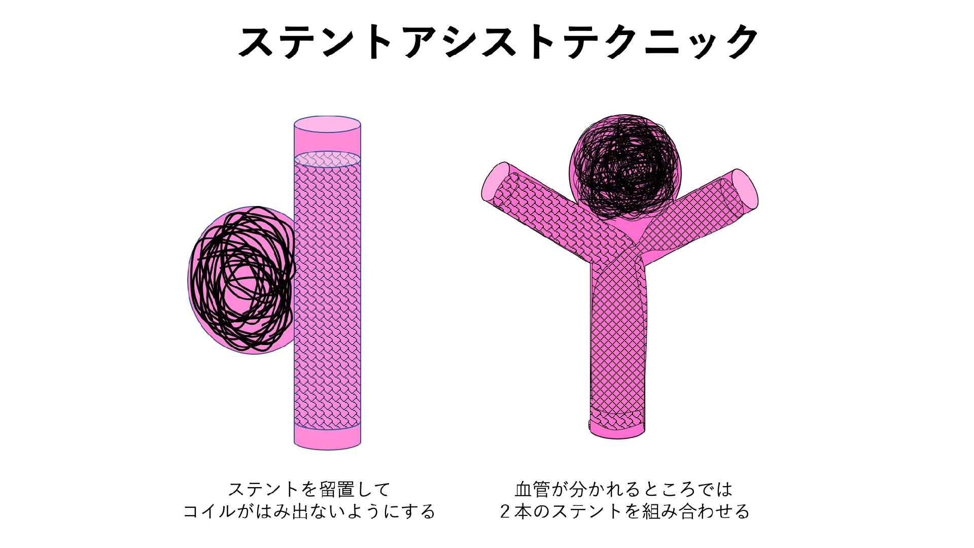 脳動脈瘤 その39 脳血管内治療：その9 ステントアシストテクニック