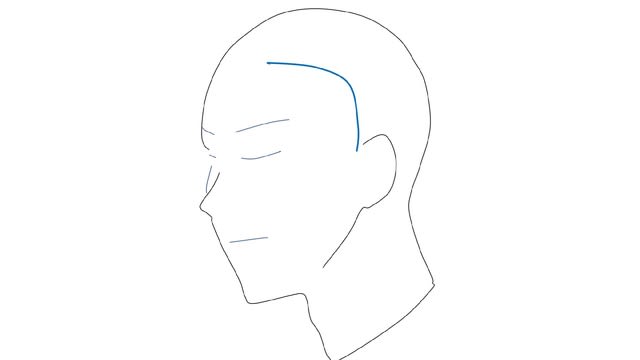 脳動脈瘤 その16 外科手術 1. クリッピング術 「どこを切るのか？」