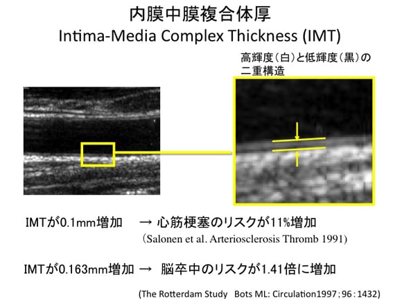 内膜中膜複合体厚とは？