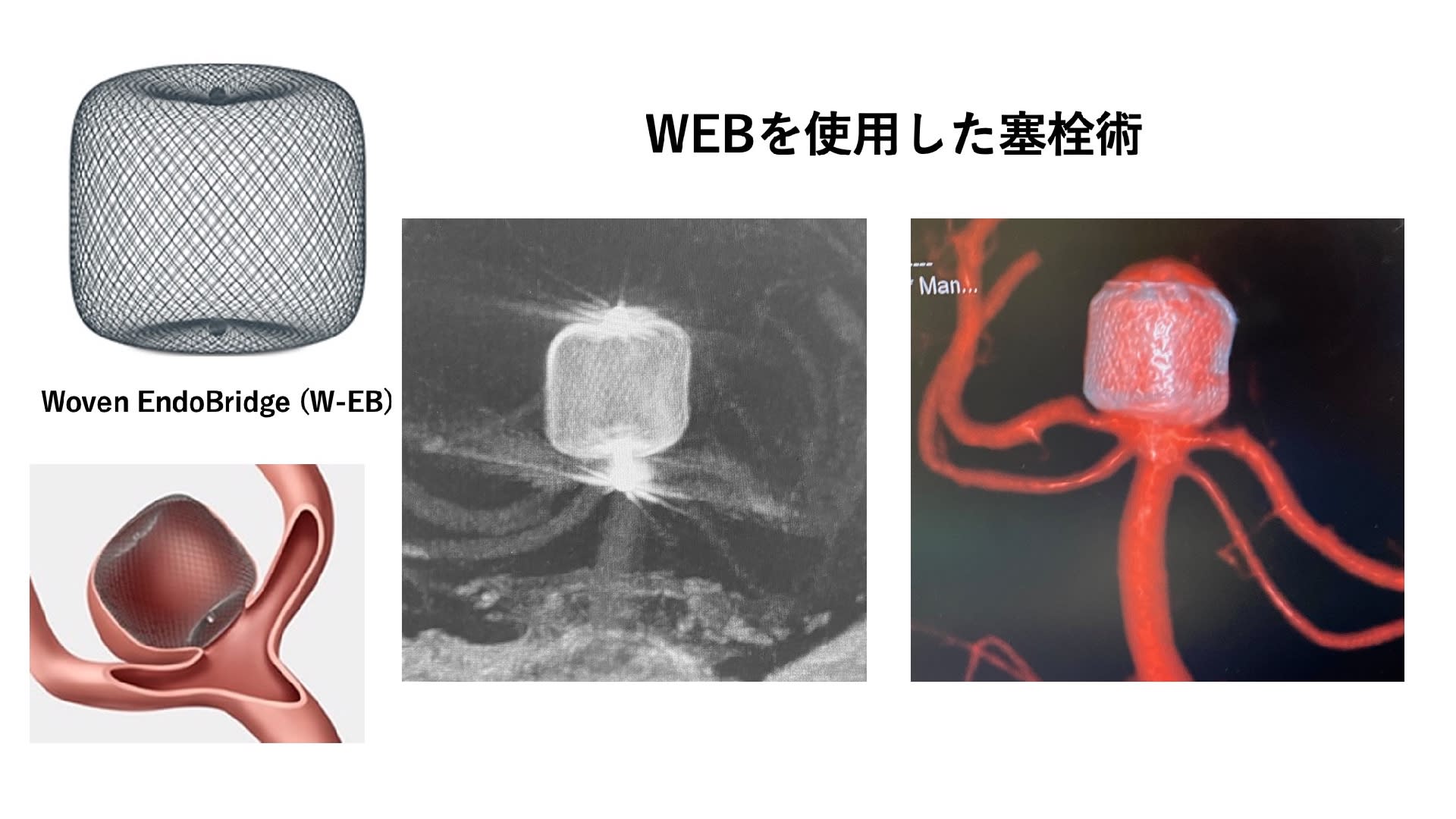 新しい脳動脈瘤治療機器、WEB上陸！