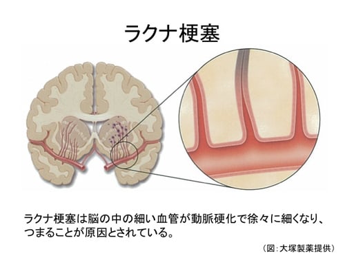 脳梗塞慢性期の病態について ラクナ梗塞ってなに?