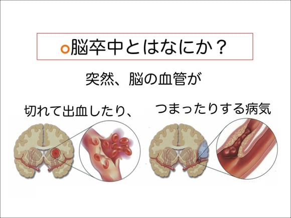 脳卒中にならない５か条　その一「敵を知り」： 脳卒中とは何か？
