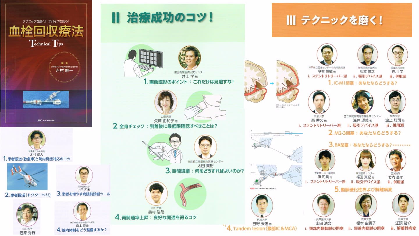 血栓回収療法 Technical Tips