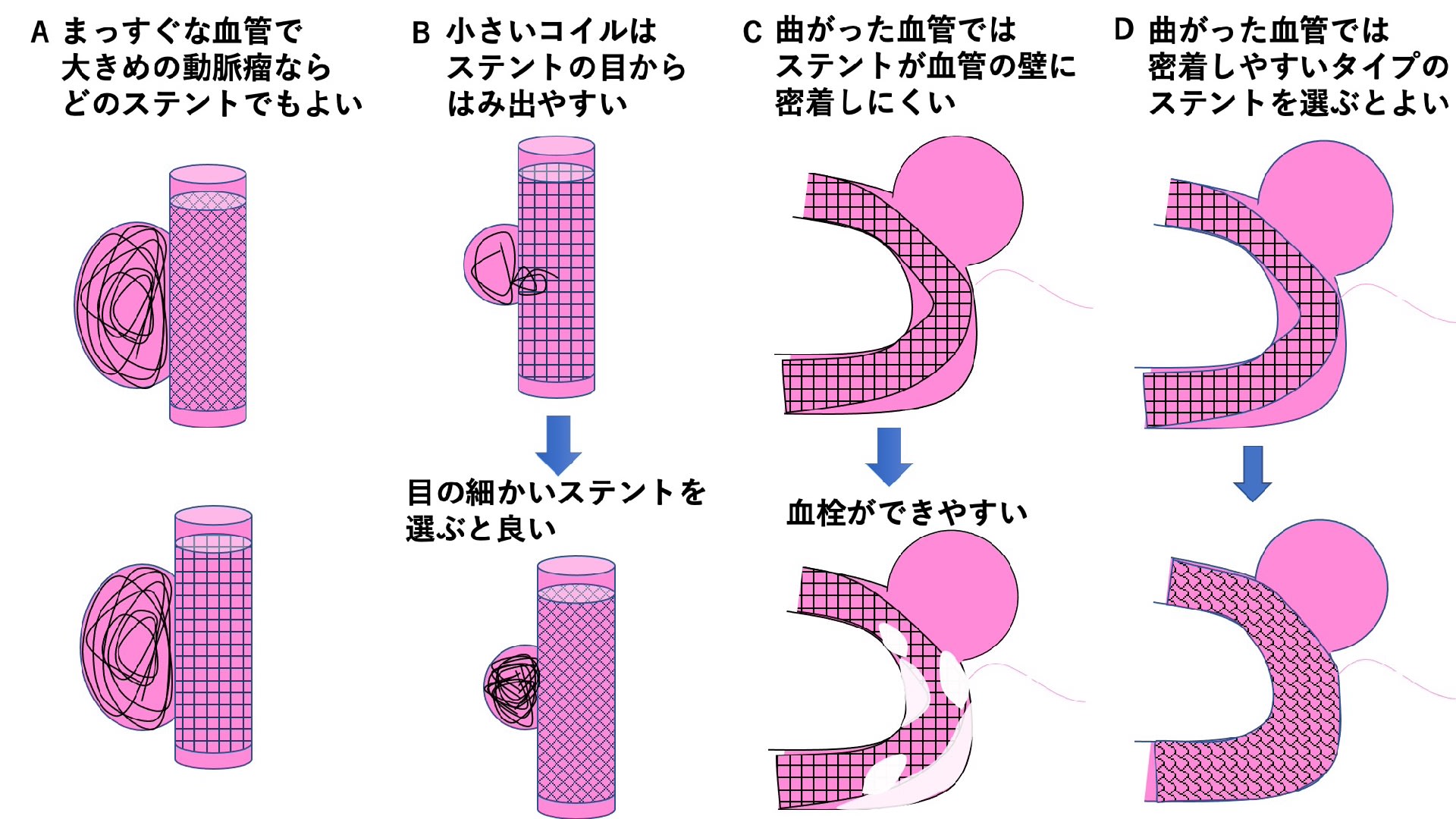 脳動脈瘤 その41 脳血管内治療:その11 ステントアシストテクニック 3