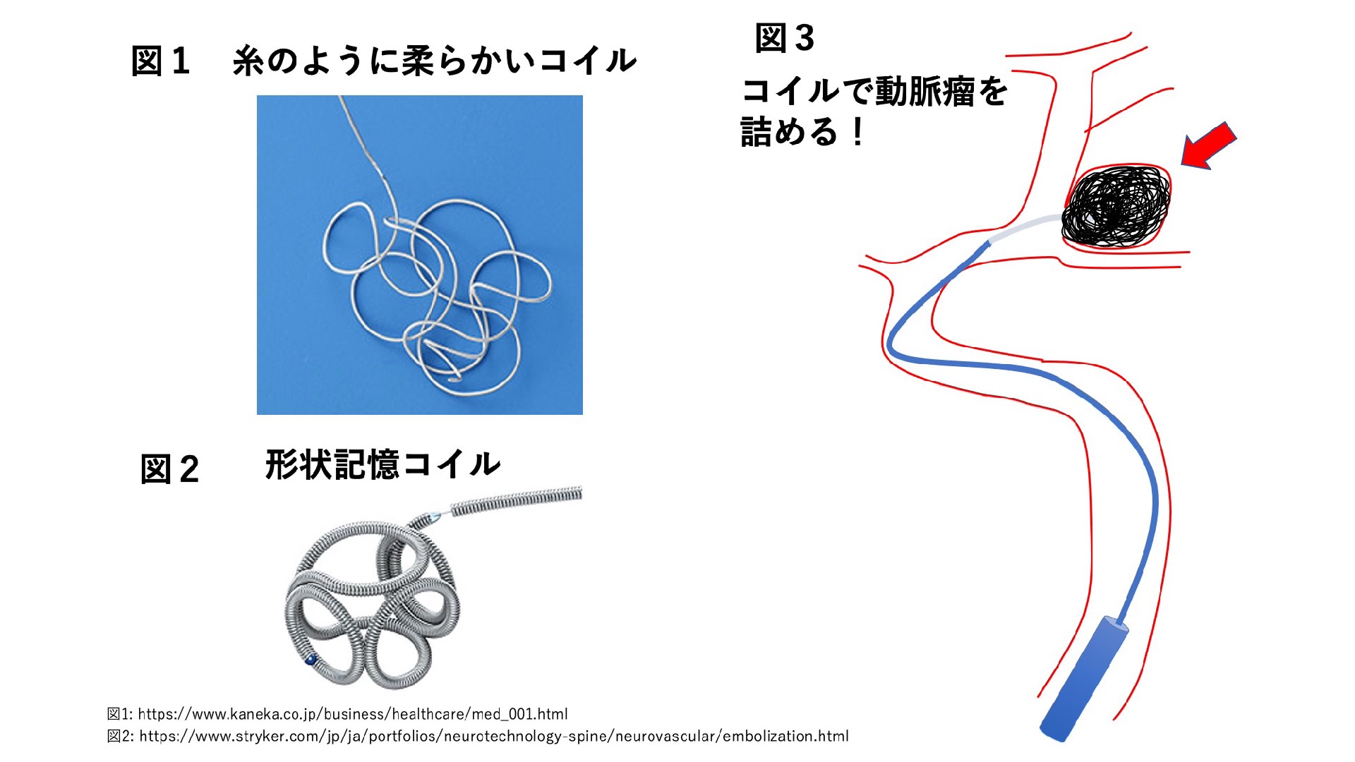 脳動脈瘤 その35 脳血管内治療：その5 コイル塞栓