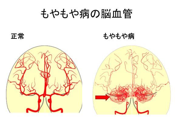 もやもや病について　その４　治療：血流を増やす　バイパス術３