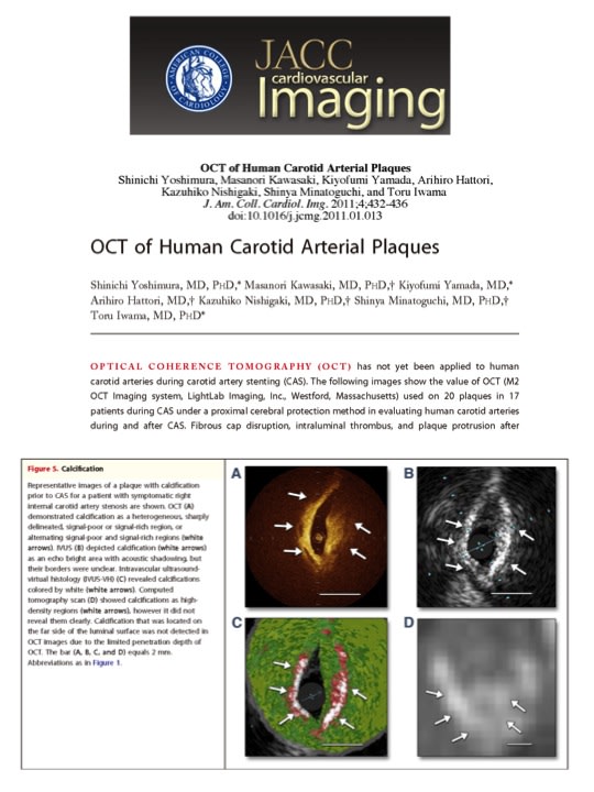 頚動脈へのOCT応用がJACC Imagingに掲載されました