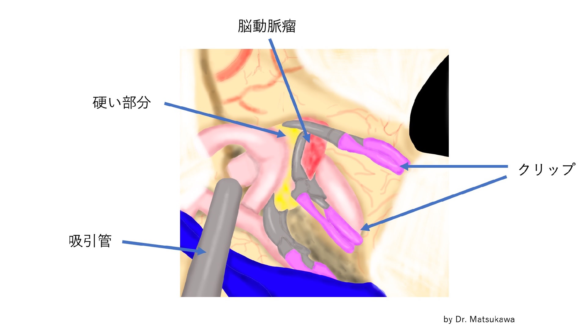 脳動脈瘤 その24 外科手術 1. クリッピング術 「複雑なクリッピング」