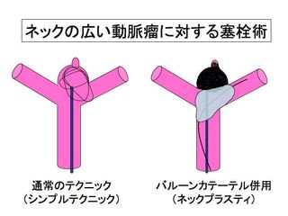 未破裂動脈瘤の治療法選択ー血管内手術（応用編）