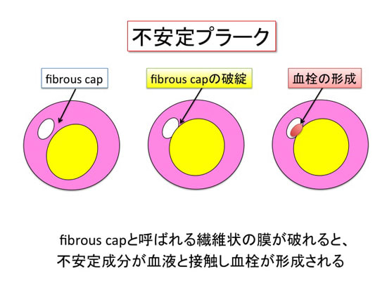 血管の狭窄５