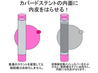 難しい動脈瘤3 メッシュカバードステント