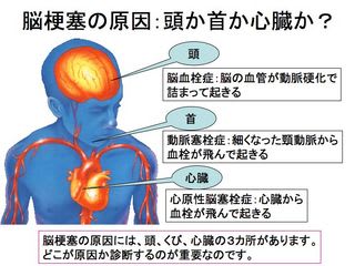 脳梗塞の原因　
