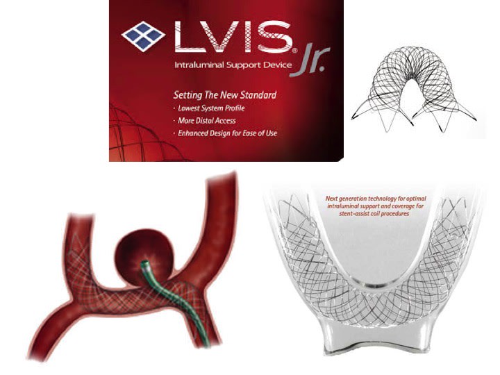 新しい動脈瘤塞栓用ステント LVIS