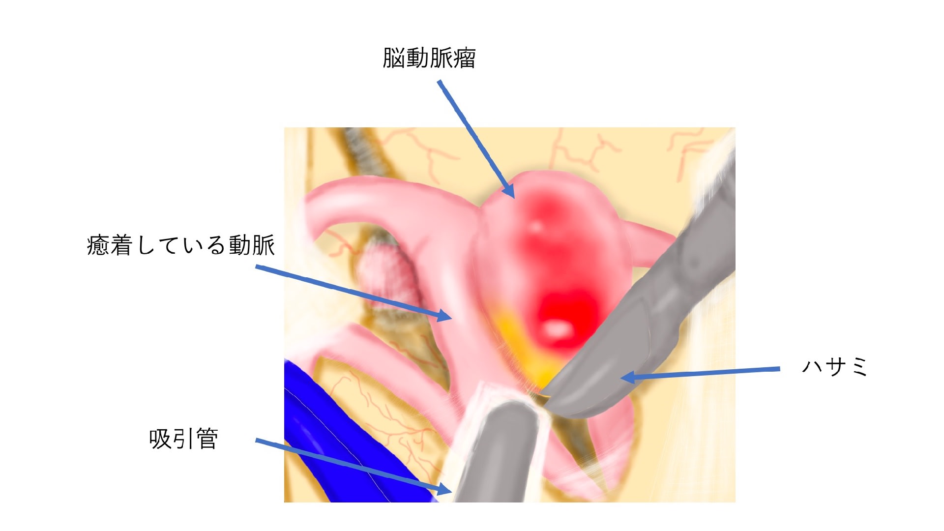 脳動脈瘤 その23 外科手術 1. クリッピング術 「難易度の高いクリップの前に重要なことは?」