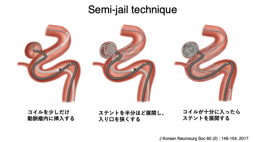 脳動脈瘤 その42 脳血管内治療：その12 ステントアシストテクニック 4