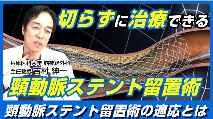 You tube 第7弾 頚動脈ステント留置術
