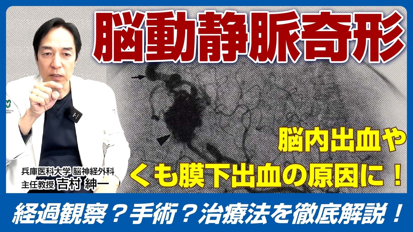 You tube 第27弾 脳動静脈奇形について