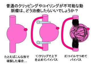 難しい動脈瘤