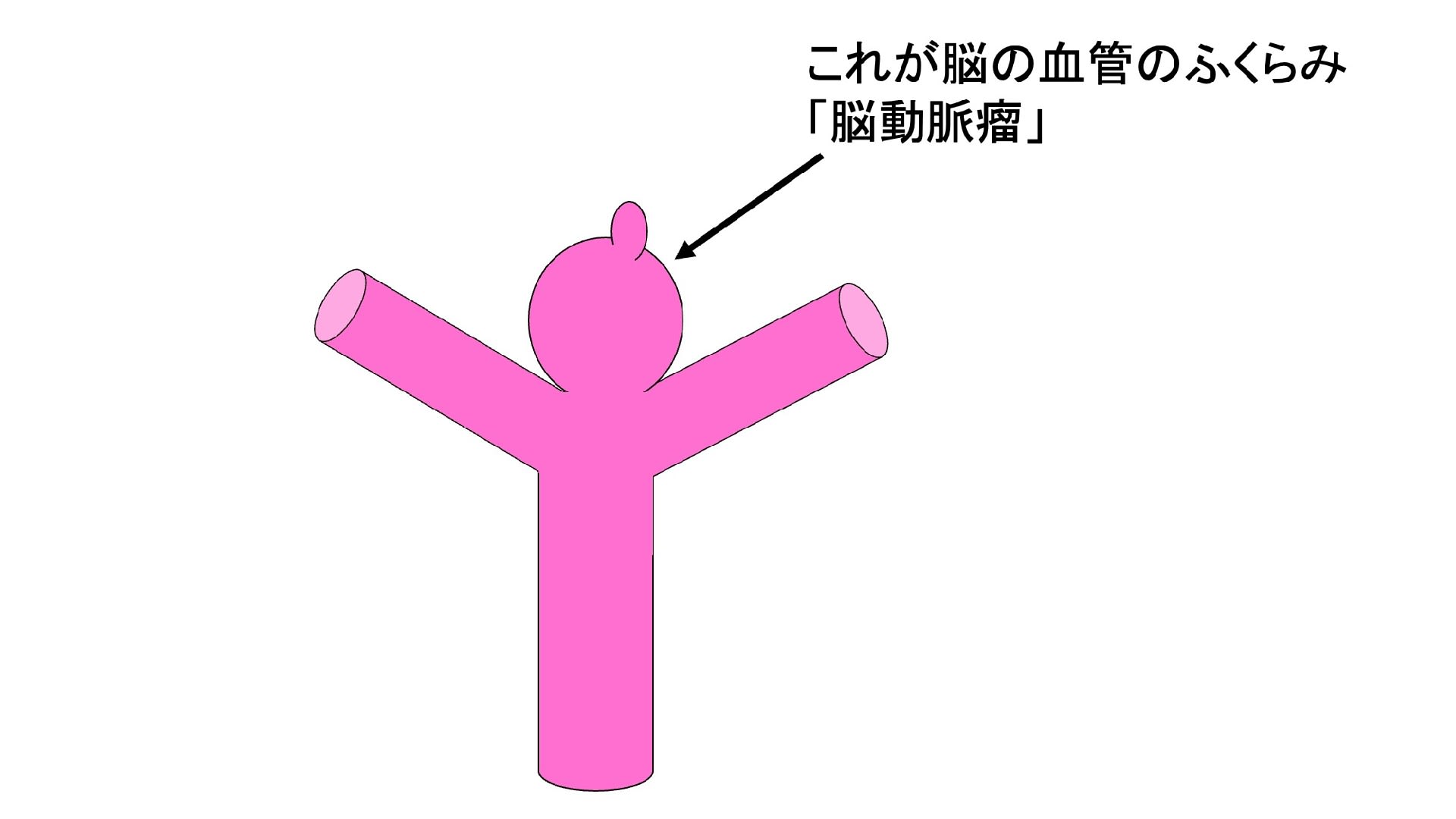 脳動脈瘤に関する質問編　その１　「脳動脈瘤って何ですか？がんなのでしょうか？」